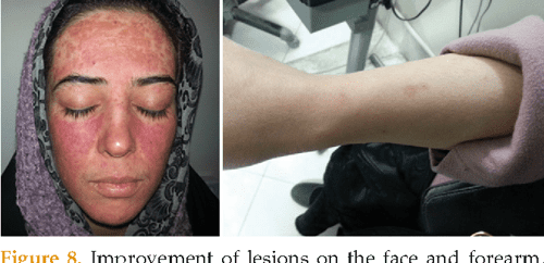 Rosacea society of america image