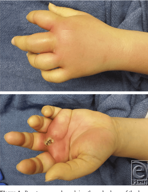 Figure 3 from Collar Button Abscess Semantic Scholar