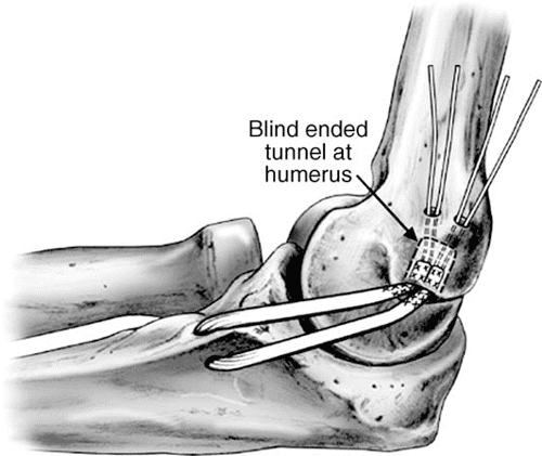 Figure 6 from Ulnar collateral ligament injury in the overhead athlete