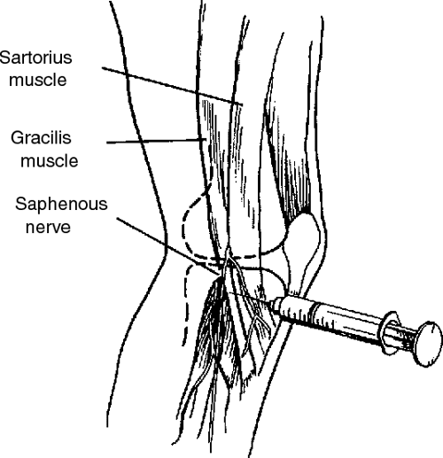 [PDF] Combined popliteal and saphenous nerve blocks at the knee an