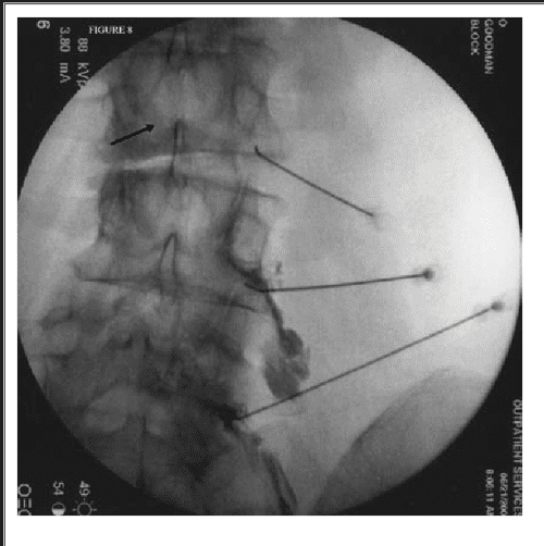 Figure 6 from Dural puncture and subdural injection a complication of lumbar transforaminal
