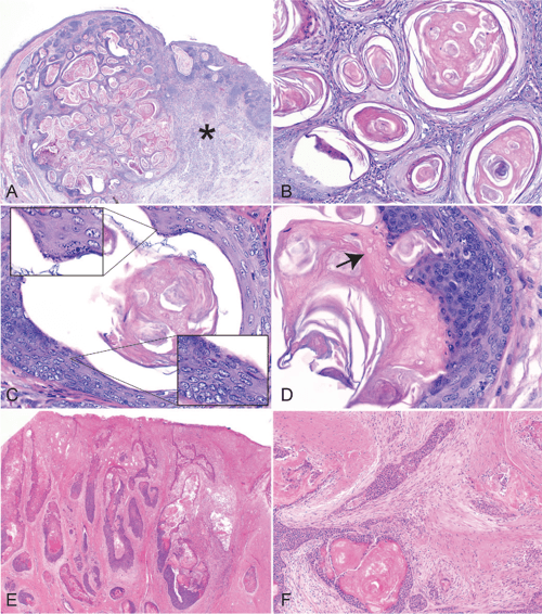 Histologic features of hair follicle neoplasms and cysts in dogs and