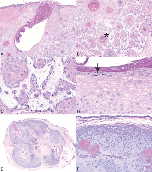 Histologic features of hair follicle neoplasms and cysts in dogs and