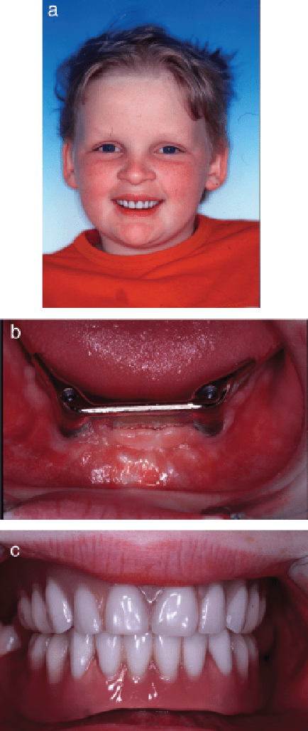 Ectodermal dysplasia hair picture