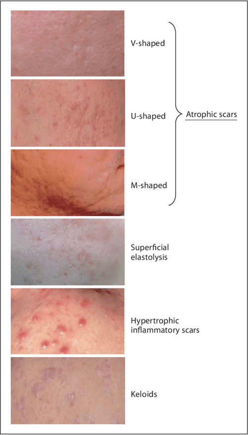 ECCA Grading Scale An Original Validated Acne Scar Grading Scale for