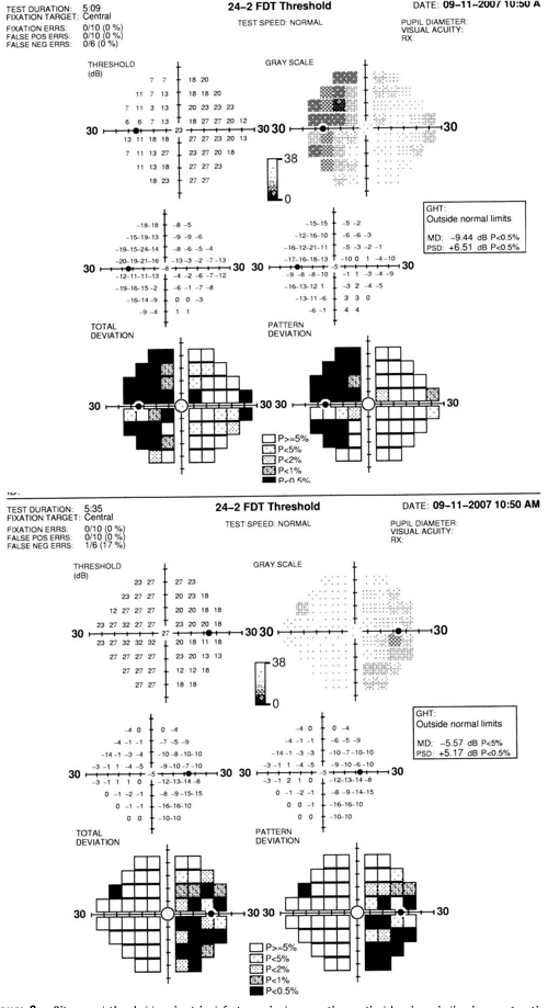 Figure 1 from Bitemporal visual field defects mimicking chiasmal ...