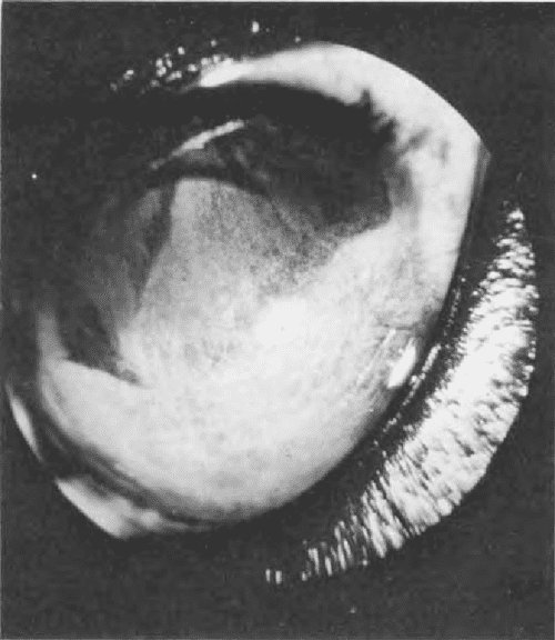 Figure 1 from Corneal pannus (chronic superficial keratitis) in the