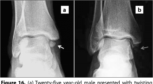 Figure 6 from The Accessory Ossicles of the Foot and Ankle; a ...