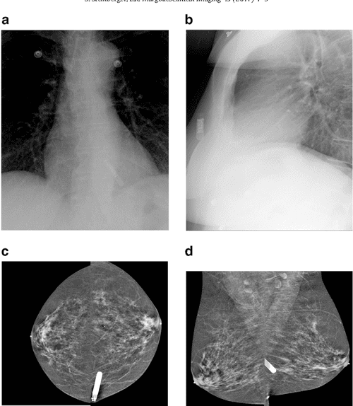 The implantable loop recorder and its mammographic appearance A case