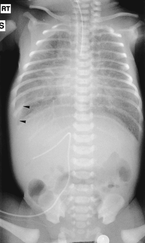 [PDF] The neonatal chest Xray. Semantic Scholar