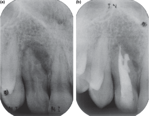 Figure 5 from Dens invaginatus. Part 2: clinical, radiographic features ...
