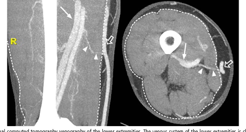 Figure 6 from Ultrasonography of the lower extremity veins: anatomy and