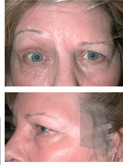 [PDF] Facial nerve injury a complication of superficial temporal