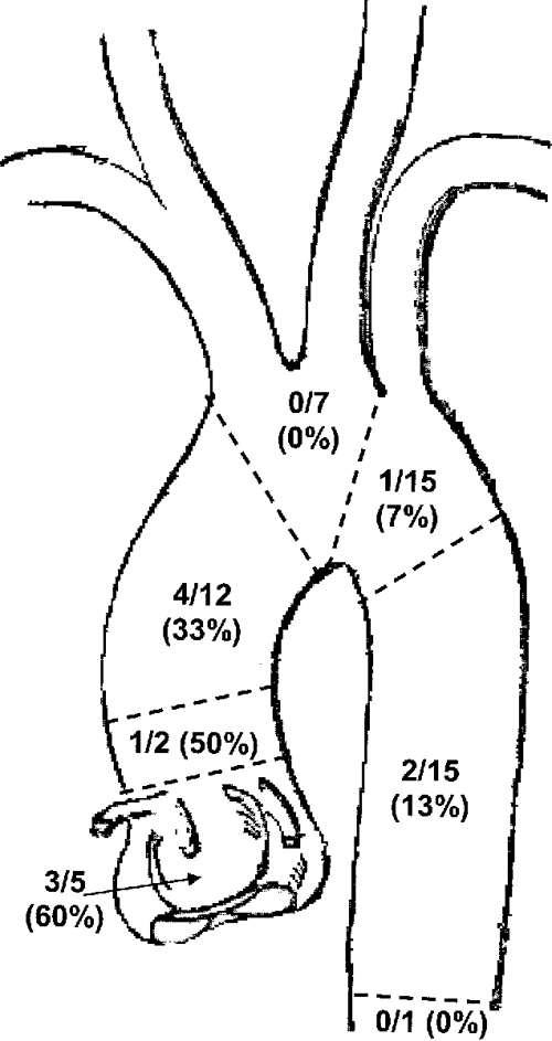 Table 8 From Acute Intramural Hematoma Of The Aorta A Mystery In 