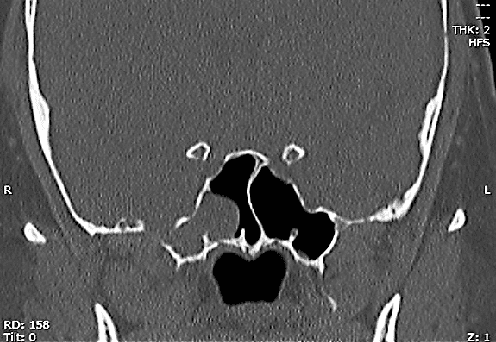 Figure 1 from Skull base anatomy and CSF rhinorrhea. | Semantic Scholar