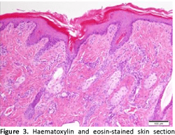 Figure 2 from Congenital Hypotrichosis with Thymus Hypoplasia in a ...