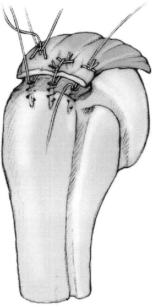 Figure 2 from A modified MasonAllen technique for rotator cuff repair