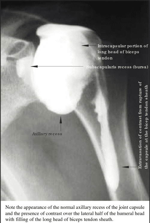 Table I from Treatment of Frozen Shoulder Using Distension Arthrography