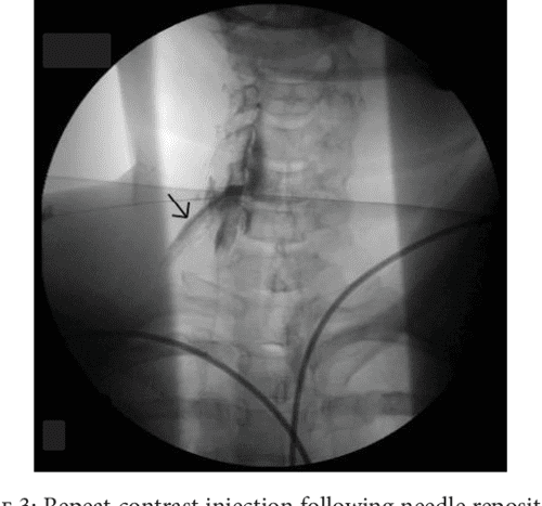 Figure 4 from Inadvertent Subdural Injection during Cervical ...