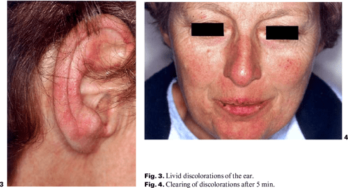 Figure 1 from Cold Agglutinin Disease – The Importance of Cutaneous ...
