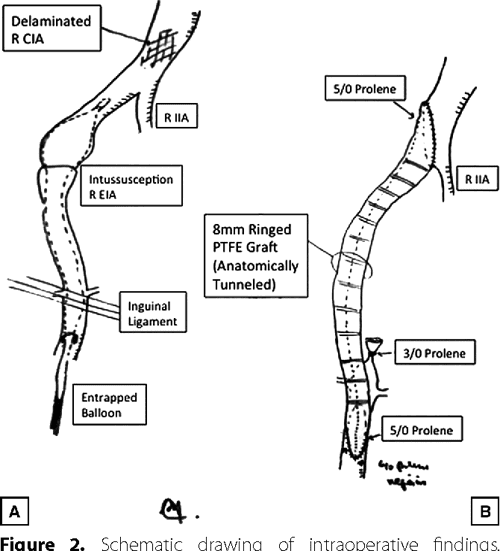 Intra aortic balloon pump physics research paper 07 image