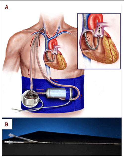 Figure 2 from Concurrent Left Ventricular Assist Device (LVAD