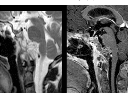 Benign and malignant diseases of the clivus. Semantic Scholar