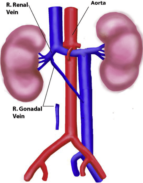Figure 1 from Right gonadal vein transposition for the treatment of