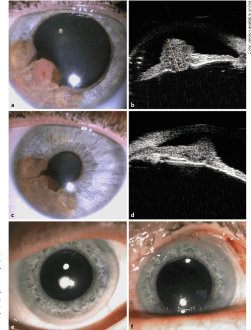 Figure 1 from Novel Eye Plaque Designs for Brachytherapy of Iris and