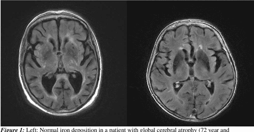 [PDF] Normal Aging of the brain | Semantic Scholar