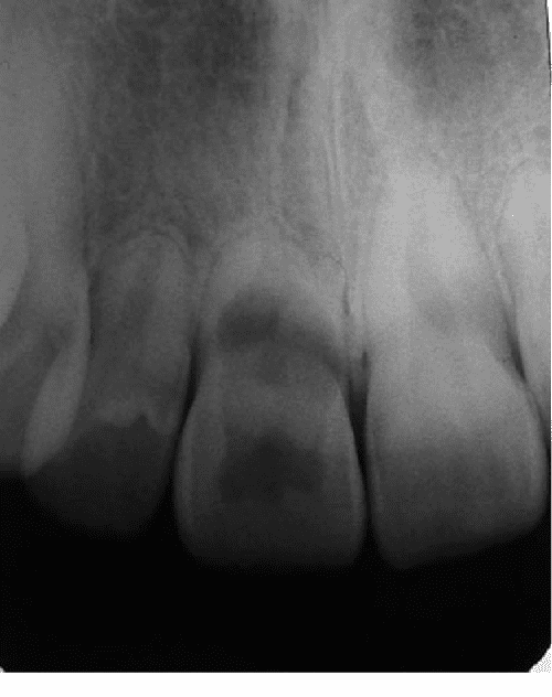 Figure 1 from Double 'pink tooth' associated with extensive internal