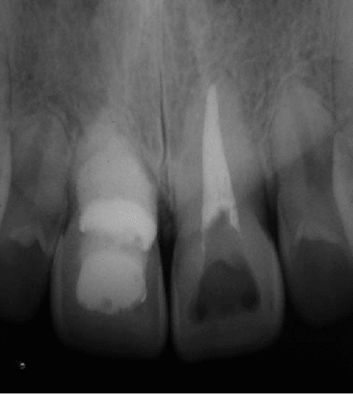 Figure 2 from Double 'pink tooth' associated with extensive internal