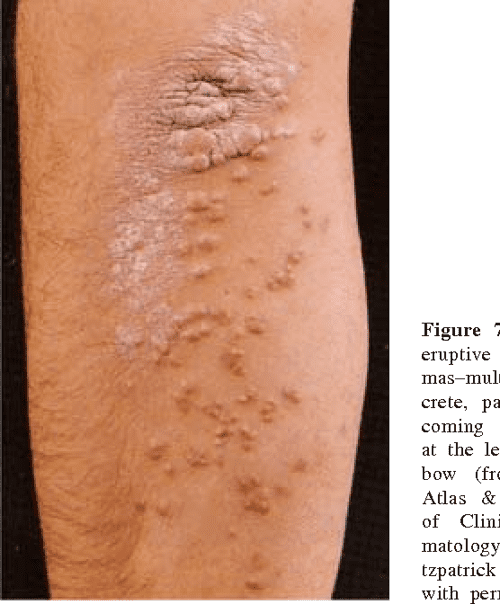 Figure 13 from Skin manifestations of liver diseases. Semantic Scholar