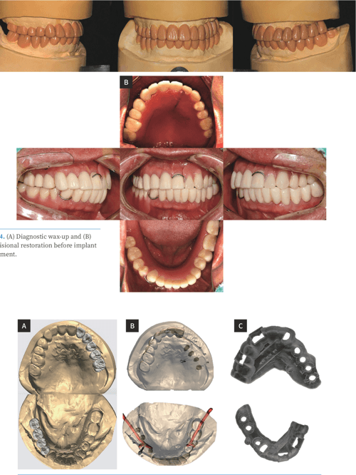 [PDF] Fullmouth rehabilitation of a patient with loss of posterior