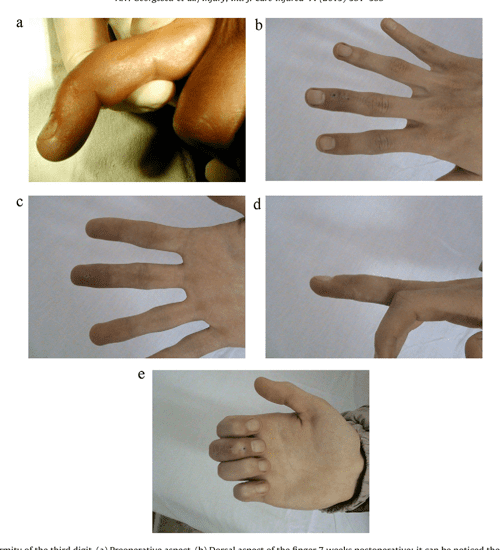 A new surgical treatment for mallet finger deformity deepithelialised pedicled skin flap