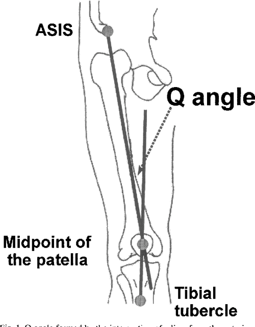 Bilateral Q angle asymmetry and anterior knee pain syndrome. Semantic