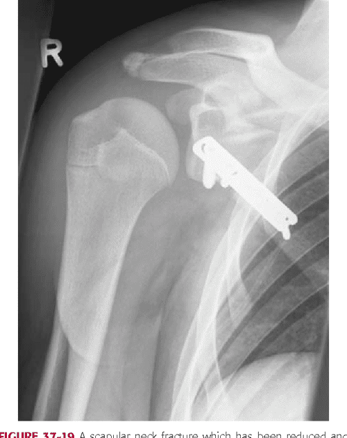 [PDF] GLENOID FRACTURES SCAPULAR NECK FRACTURE THE SUPERIOR SHOULDER