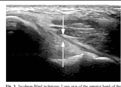 Ultrasound evaluation of the ulnar collateral ligament of Ultrasound evaluation of the ulnar collateral ligament of
