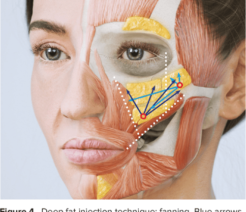 Figure 4 from Injection Guidelines for Treating Midface Volume ...