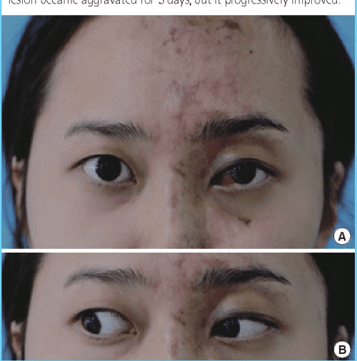 Figure 4 from Skin Necrosis with Oculomotor Nerve Palsy Due to a