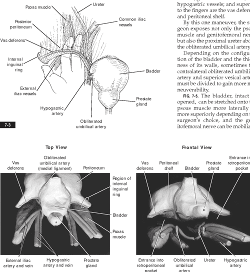 Figure 711 from PSOAS HITCH , BOARI FLAP , AND COMBINATION OF PSOAS