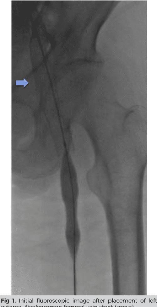Figure 1 from Common femoral vein stent placement in a frozen abdomen