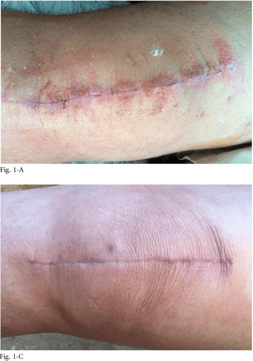 Figure 3 from Allergic Dermatitis After Total Knee Arthroplasty Using