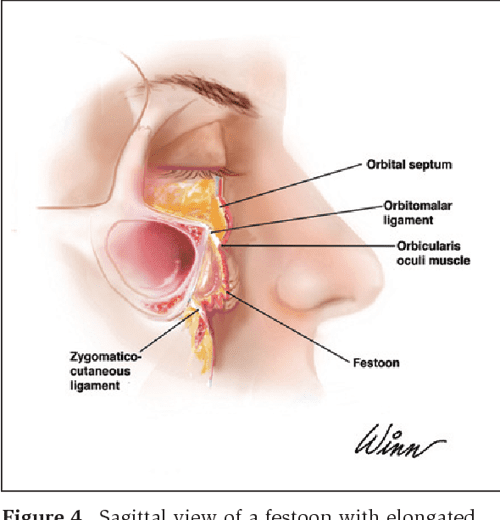 [PDF] Malar mounds and festoons review of current management