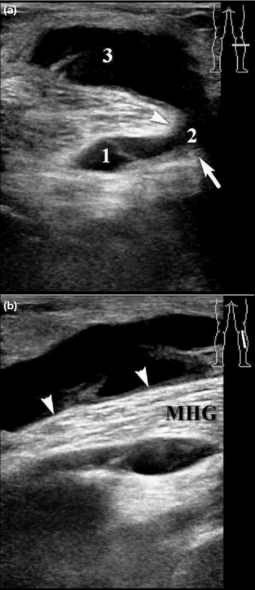 Figure 3 from Sonography of Baker’s Cyst (Popliteal Cyst) the Typical