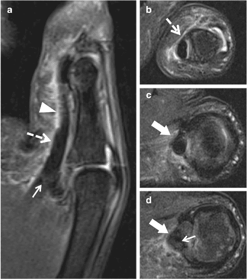 MR imaging findings of trigger thumb Semantic Scholar