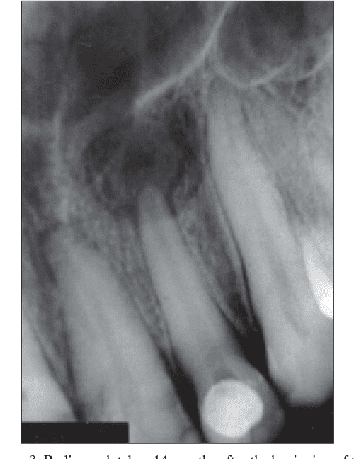 [PDF] Periapical cyst repair after nonsurgical endodontic therapycase