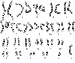 [PDF] Mosaic ring chromosome 18; ring chromosome 18 duplication