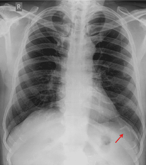 Radiology of ribs Spectrum of normal variants and pathological conditions Emphasis on chest