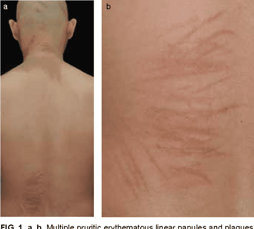 [PDF] Bleomycin-induced flagellate erythema. | Semantic Scholar